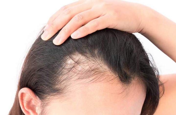 Caduta dei capelli, come prevenirla?